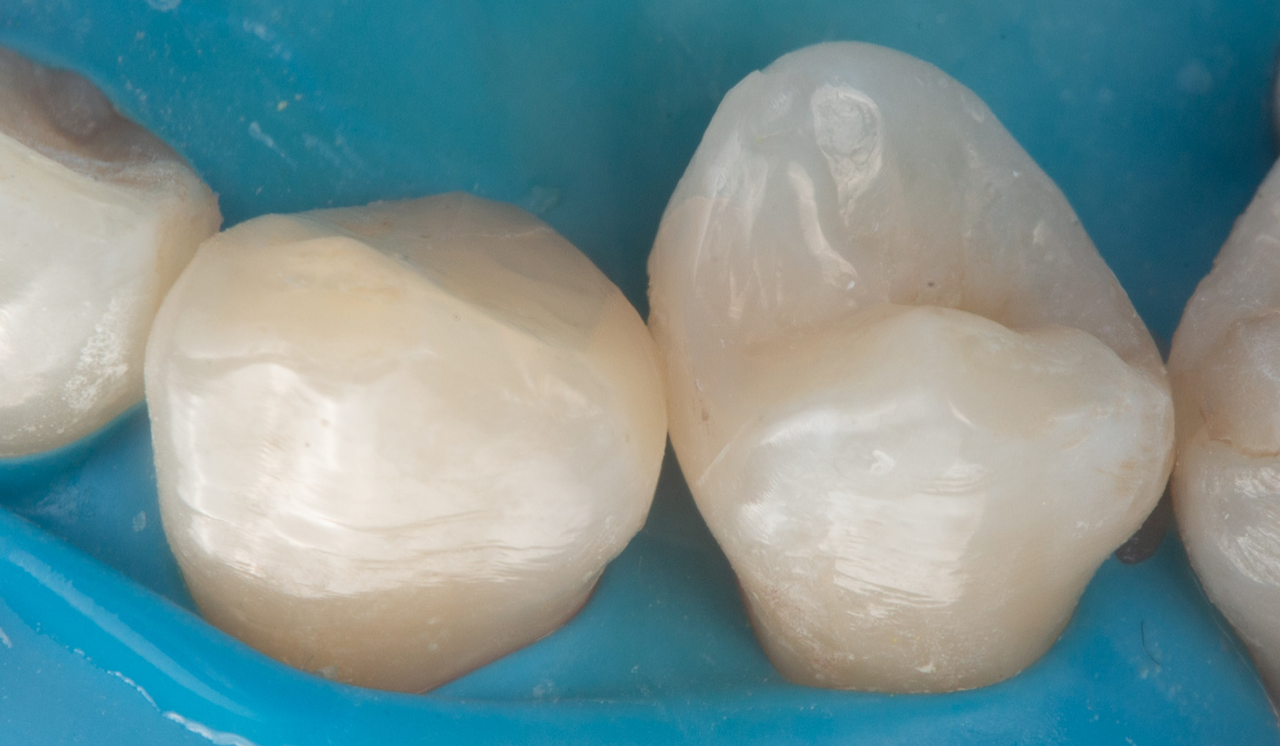 Fig. 11: Buccal view of the final restorations of teeth #23 and #24, showing colour blending, anatomical form, and surface gloss.